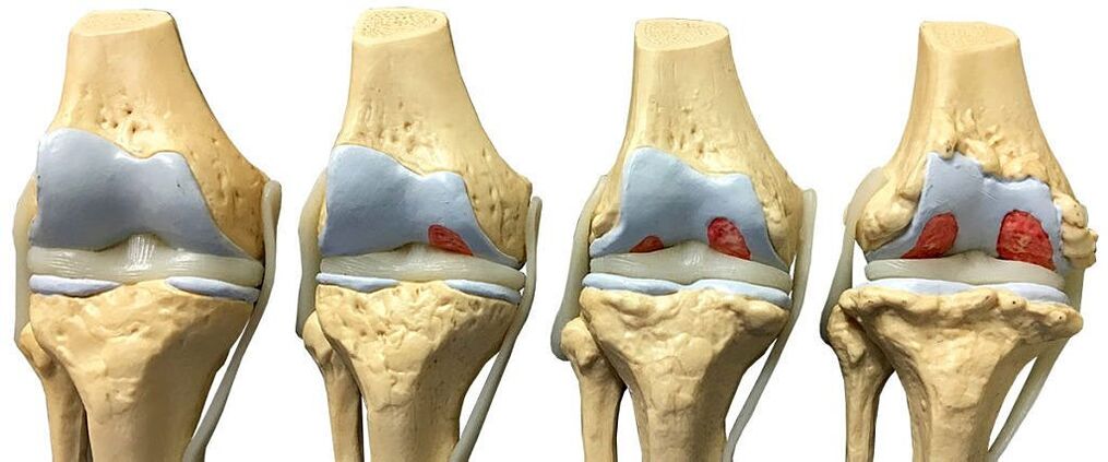 Βαθμοί οστεοαρθρίτιδας της άρθρωσης του γόνατος